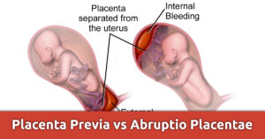 Placenta Previa vs Abruptio Placentae NCLEX Review - QD Nurses